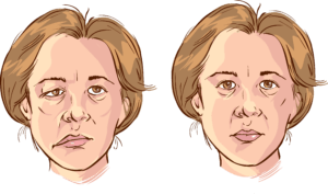 Facial Paralysis Illustration