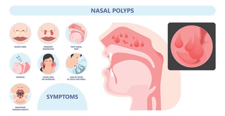 Nasal Polyps Houston Nasal Polyp Removal The Woodlands