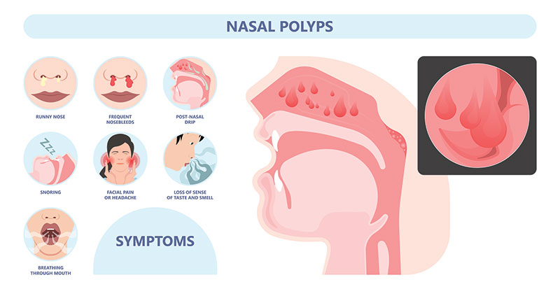 Nasal Polyps Symptoms Illustration