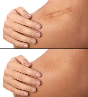 before & after scar revision