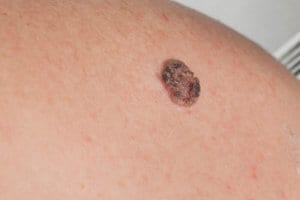 skin cancer example