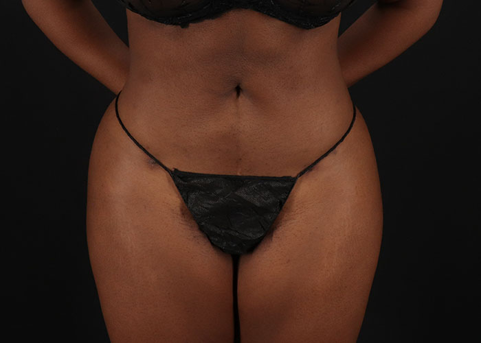 Seven things you need to know about a Brazilian butt lift