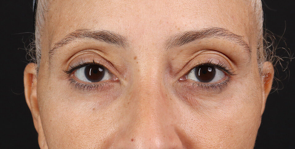 Before - 54233-70652-RR