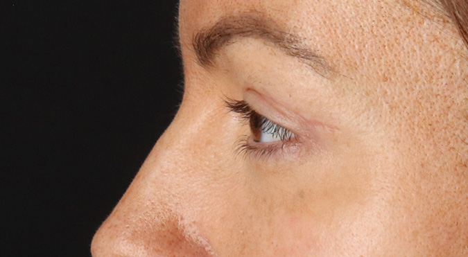 After - left_lateral