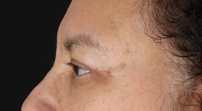 After - left_lateral