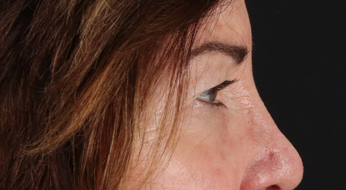 Before - right_lateral