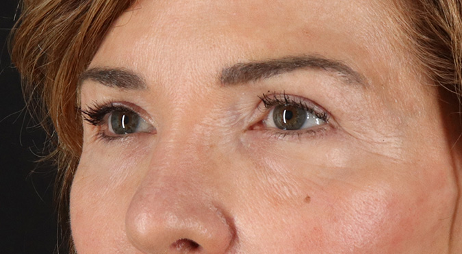 After - left_oblique