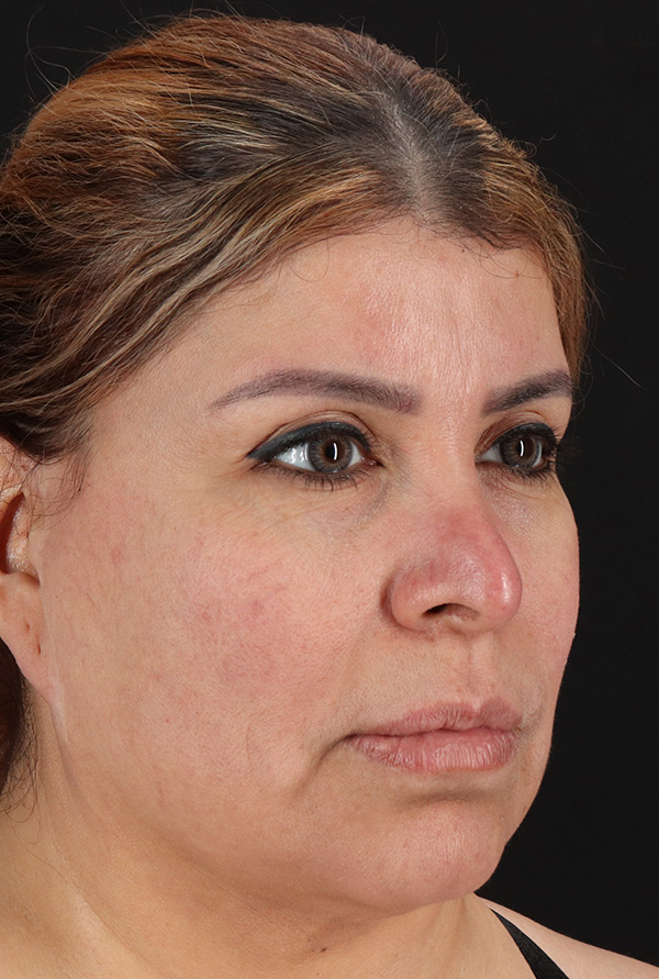 Before - right_oblique