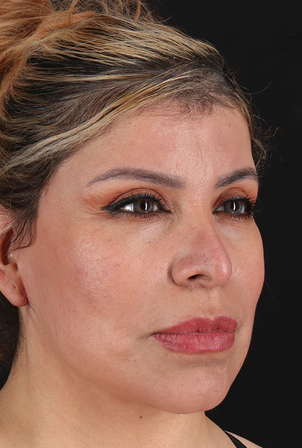 After - right_oblique