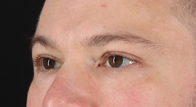 After - left_oblique