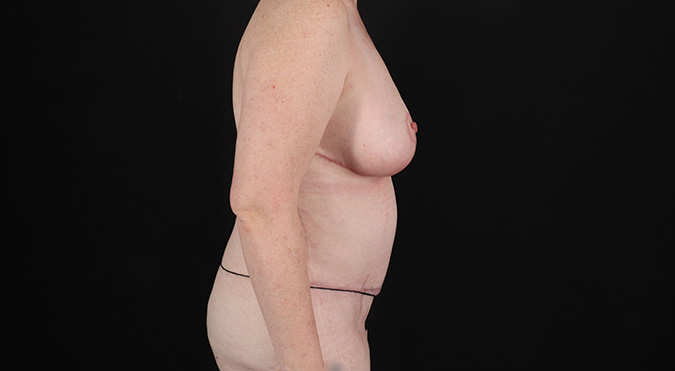 After - right_lateral