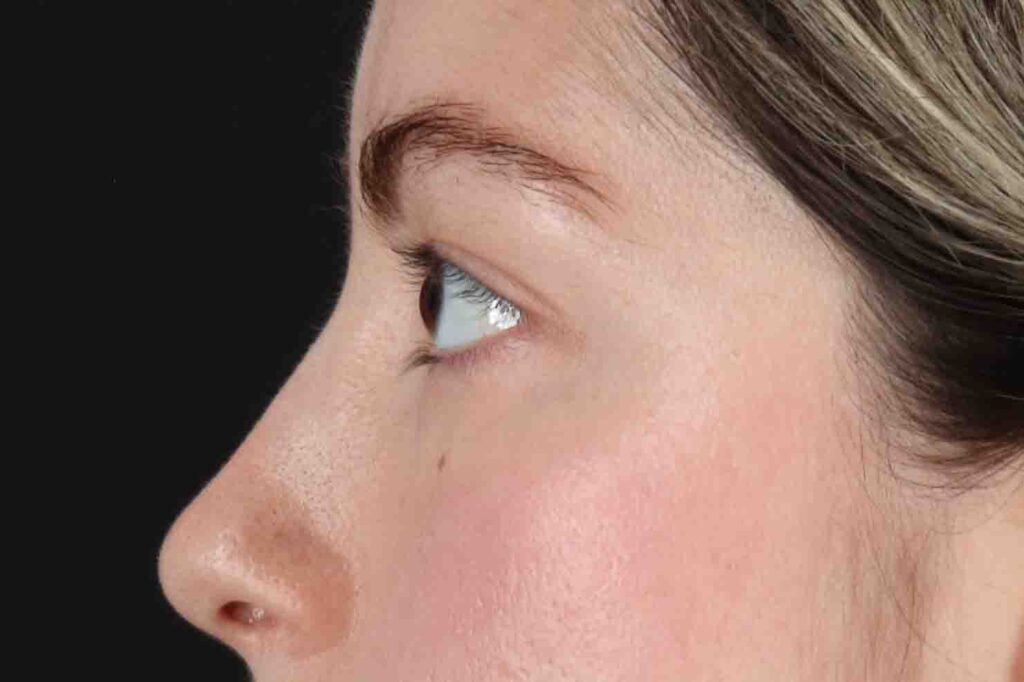 Before - left_lateral