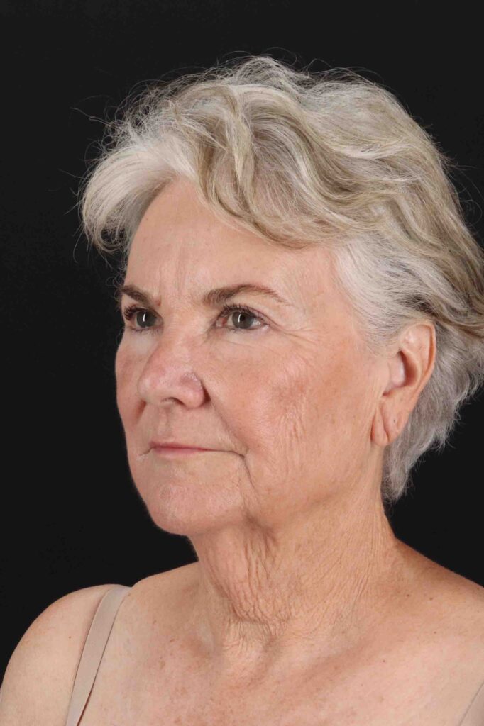 Before - left_oblique