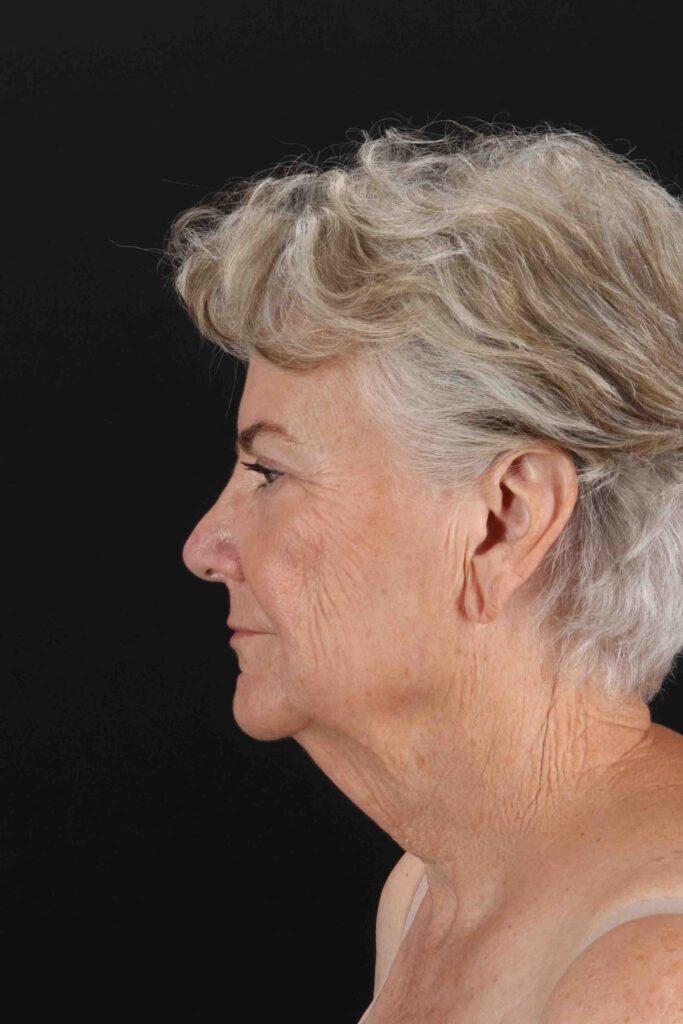 Before - left_lateral