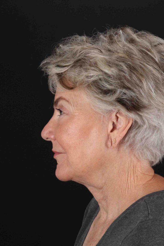 After - left_lateral