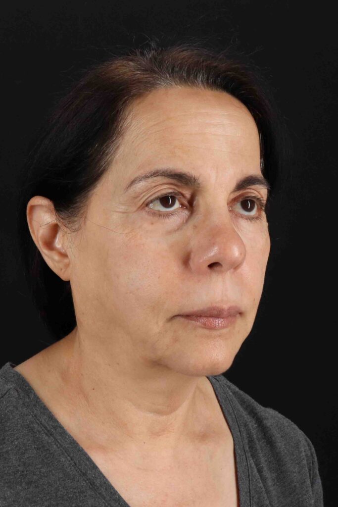 Before - right_oblique