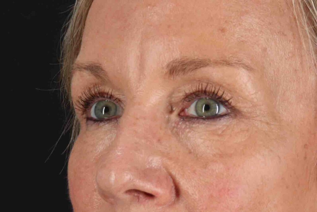 Before - left_oblique