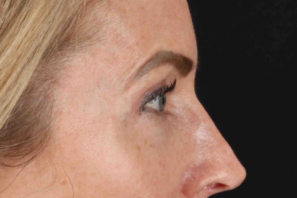 After - right_lateral