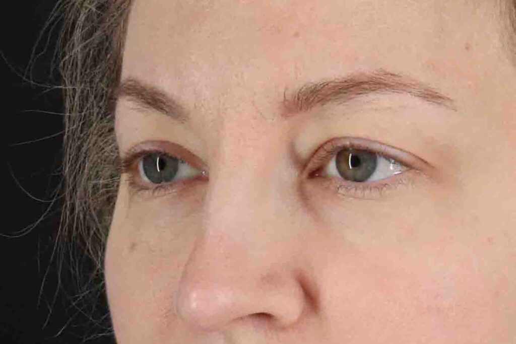 Before - left_oblique