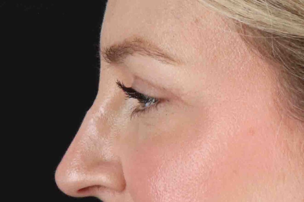 After - left_lateral