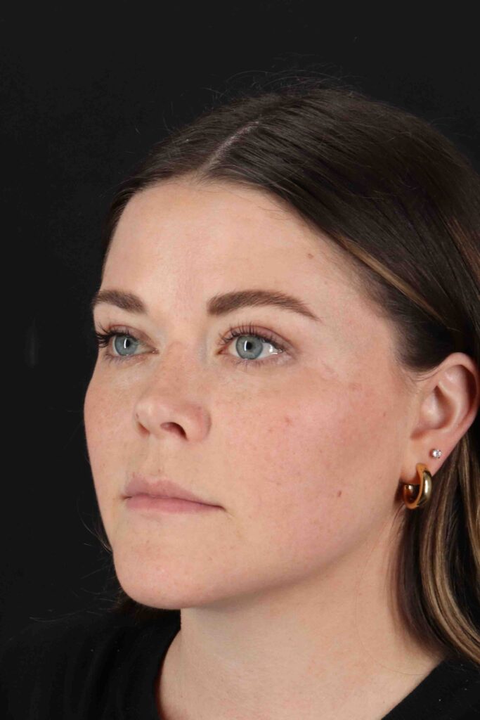 After - left_oblique