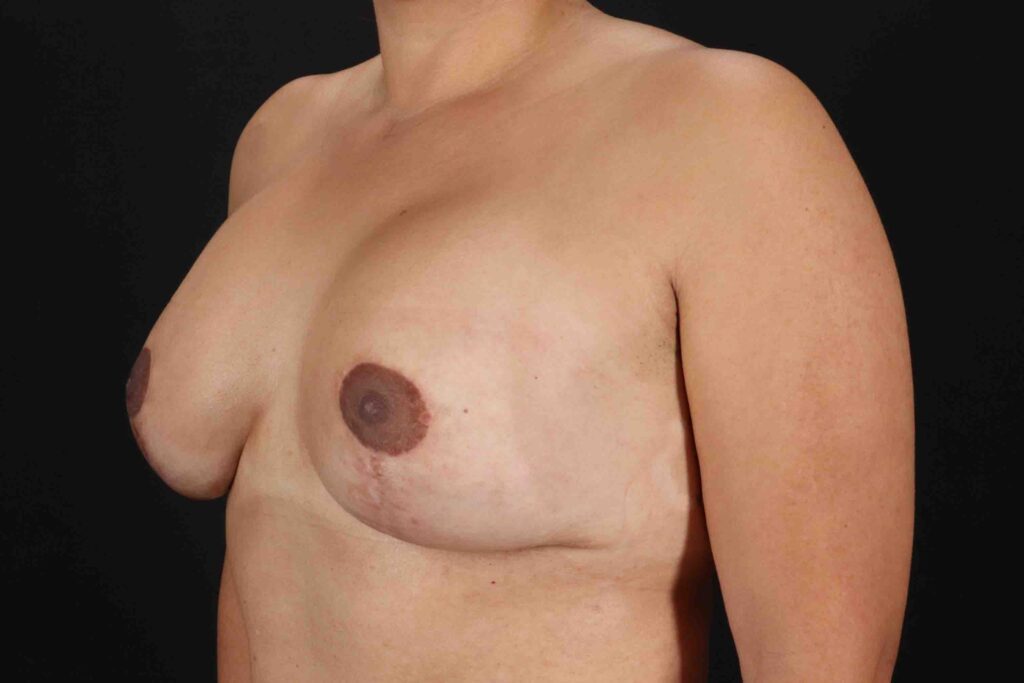 After - left_oblique