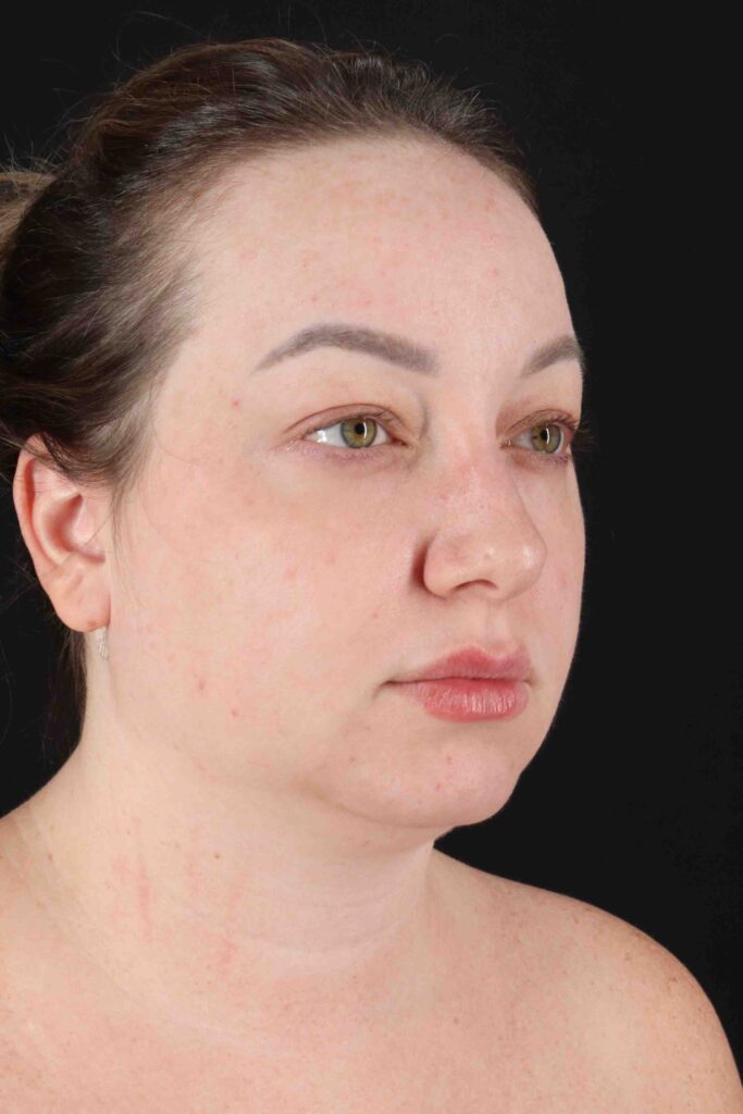 Before - right_oblique