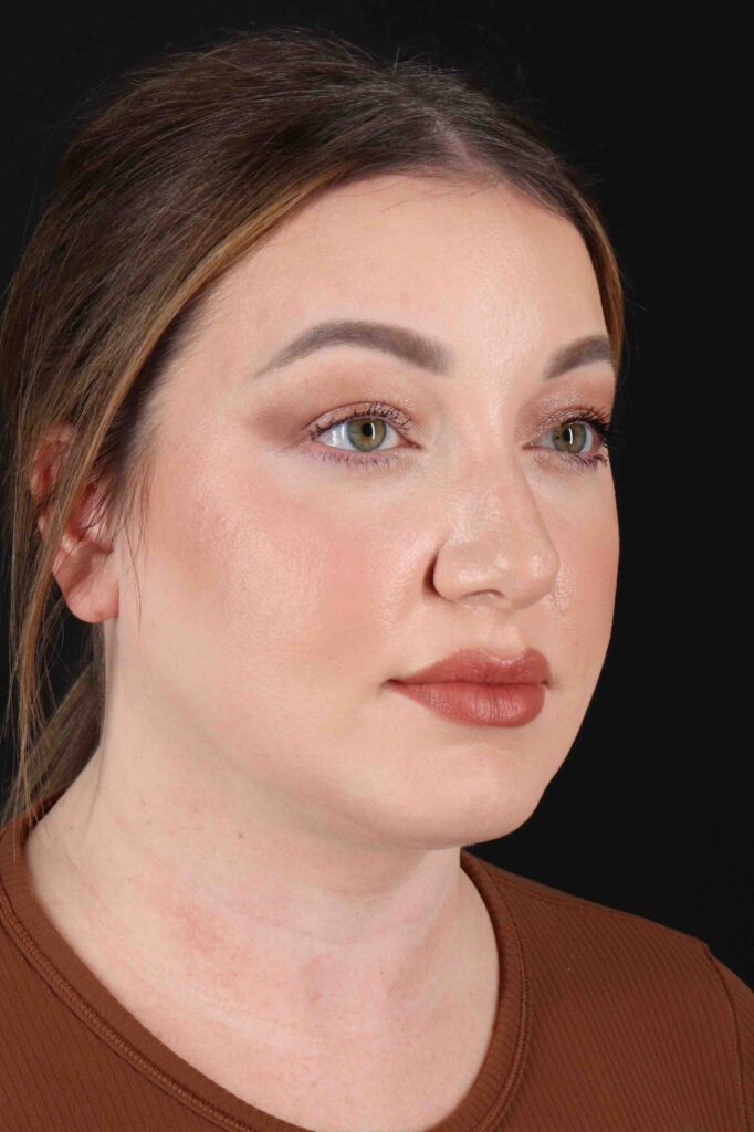 After - right_oblique