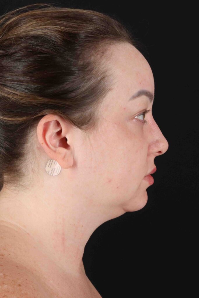 Before - right_lateral