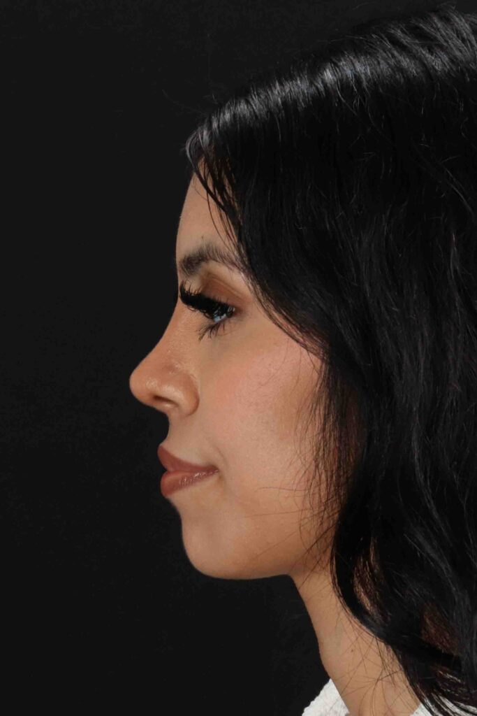 After - left_lateral