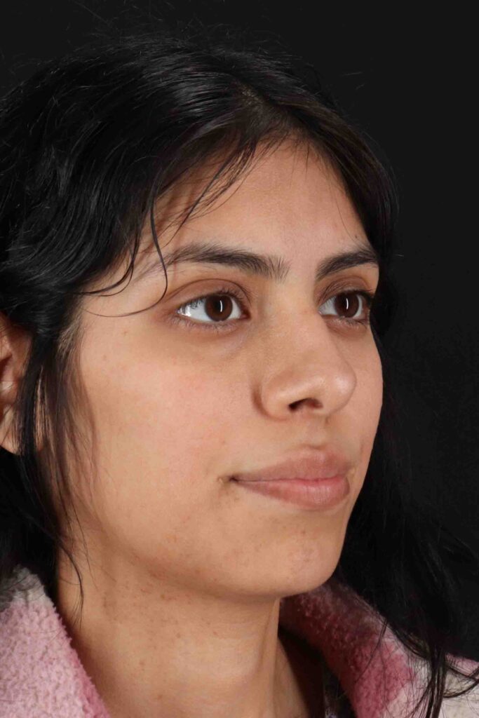 Before - right_oblique