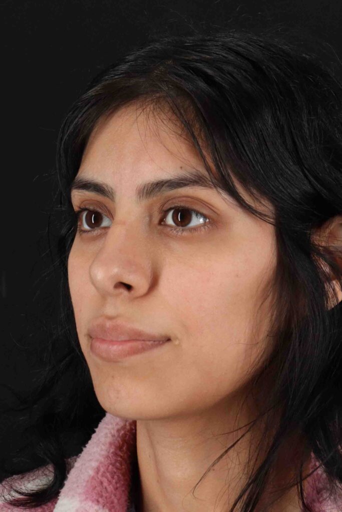 Before - left_oblique