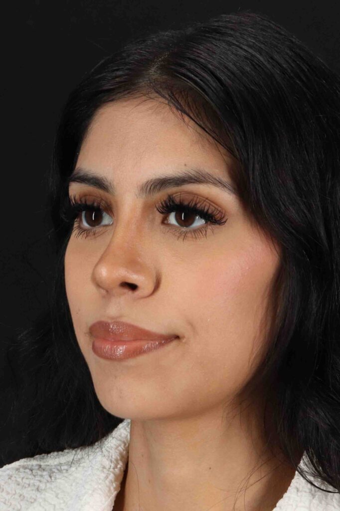 After - left_oblique