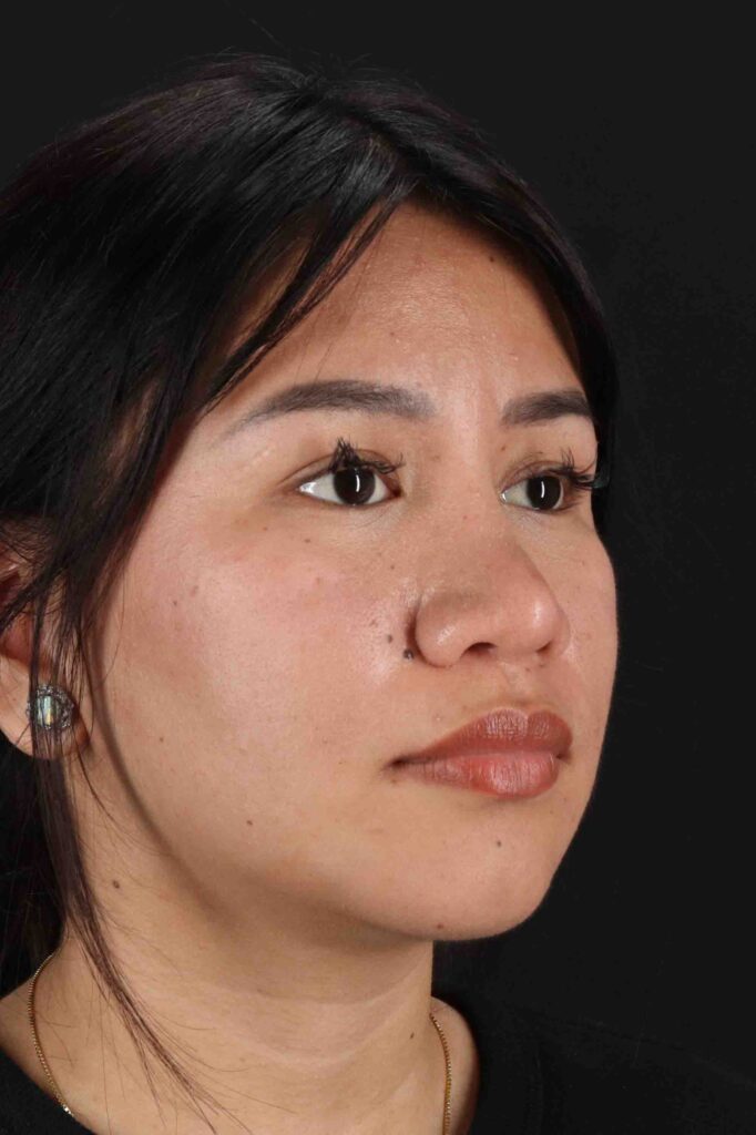 After - right_oblique