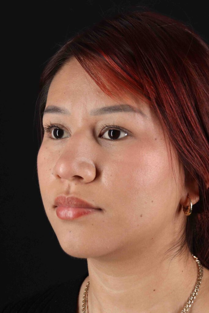 Before - left_oblique