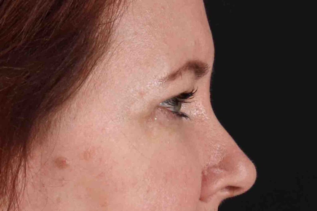 After - right_lateral