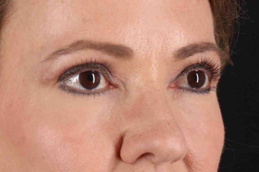 After - right_oblique