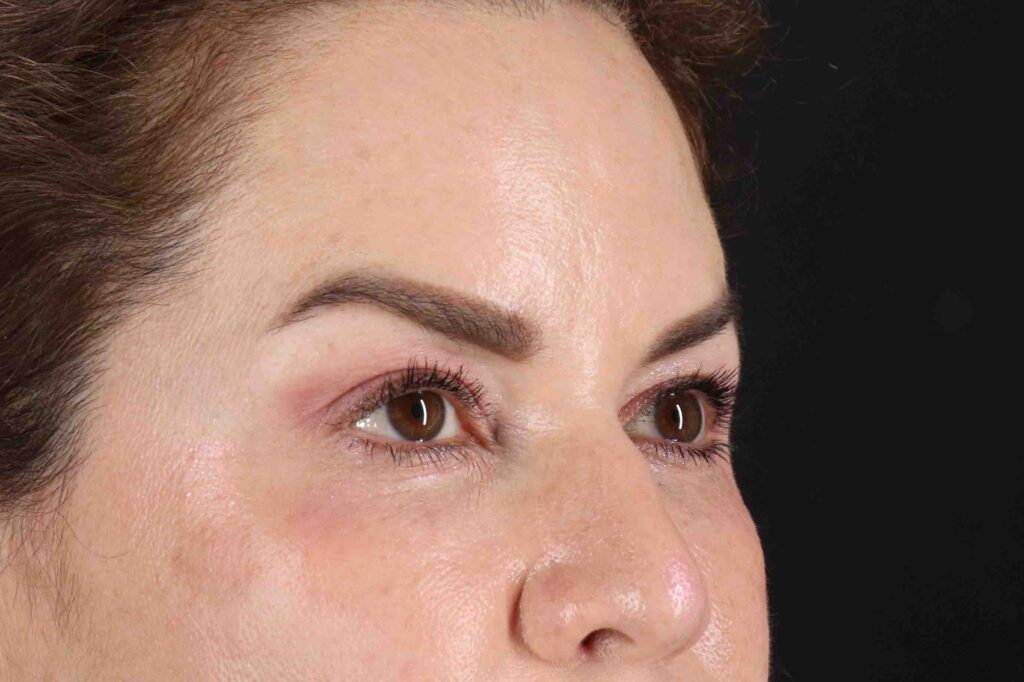 Before - right_oblique