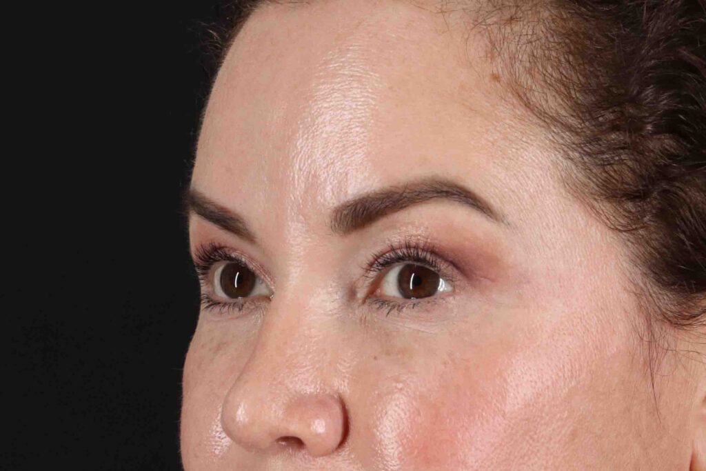 Before - left_oblique