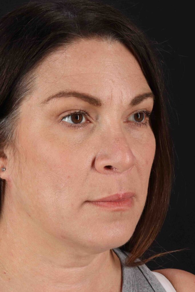 After - right_oblique