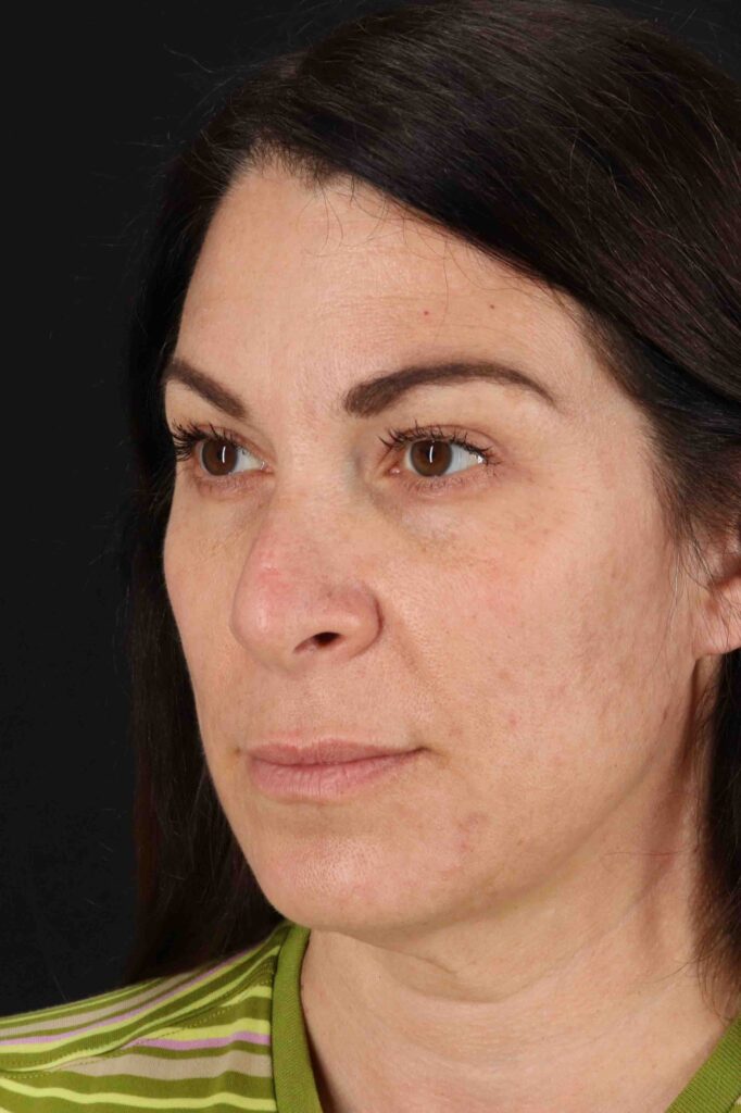 Before - left_oblique