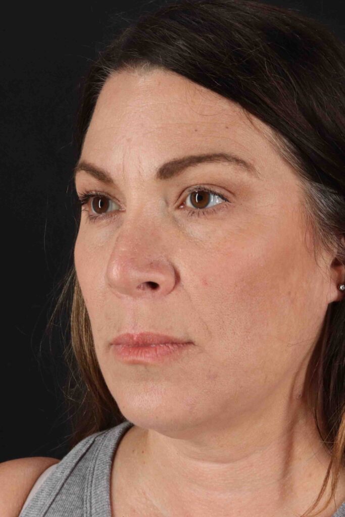 After - left_oblique