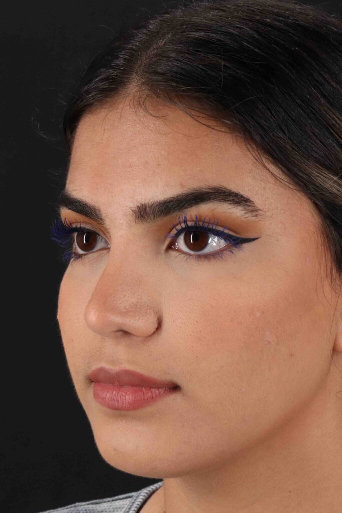 After - left_oblique