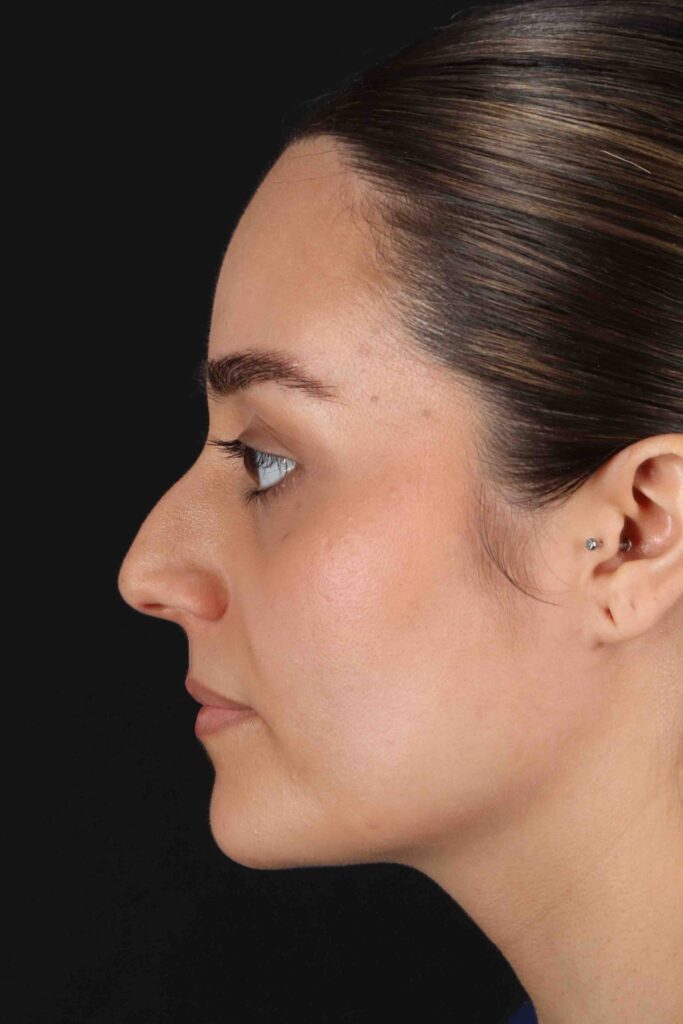 Before - left_lateral