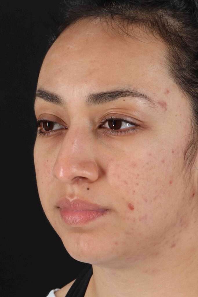 Before - left_oblique