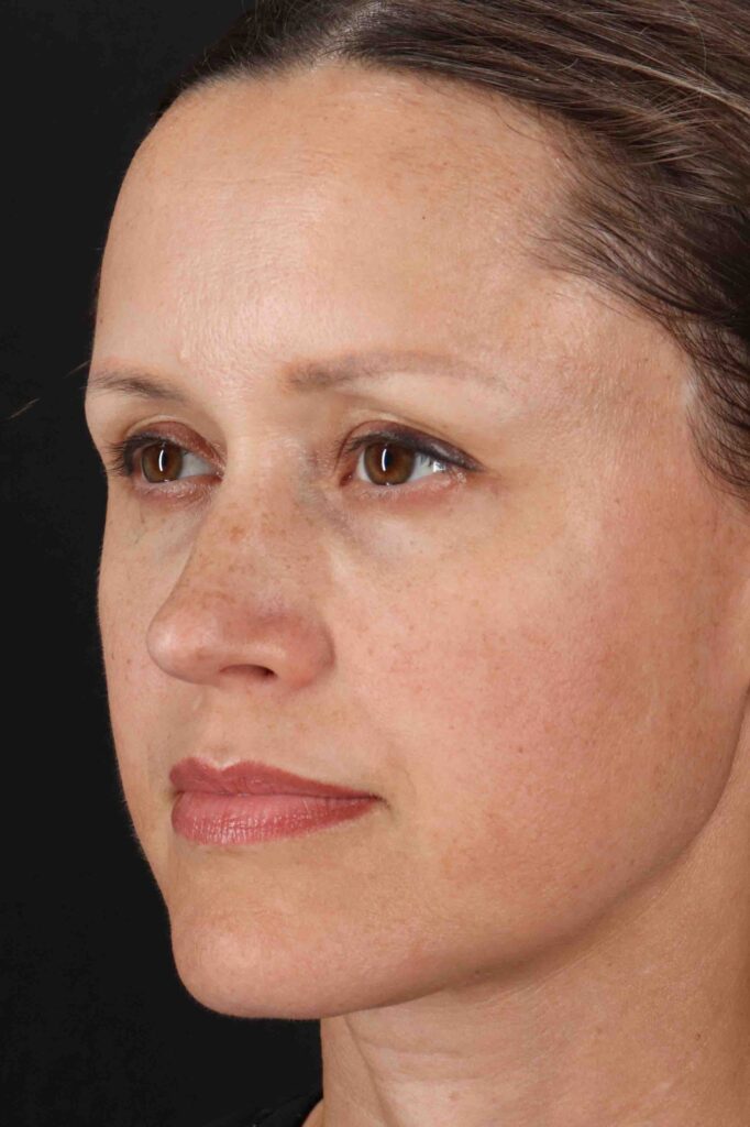 After - left_oblique