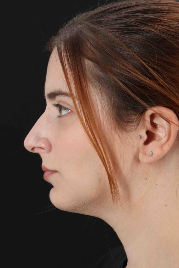 Before - left_lateral