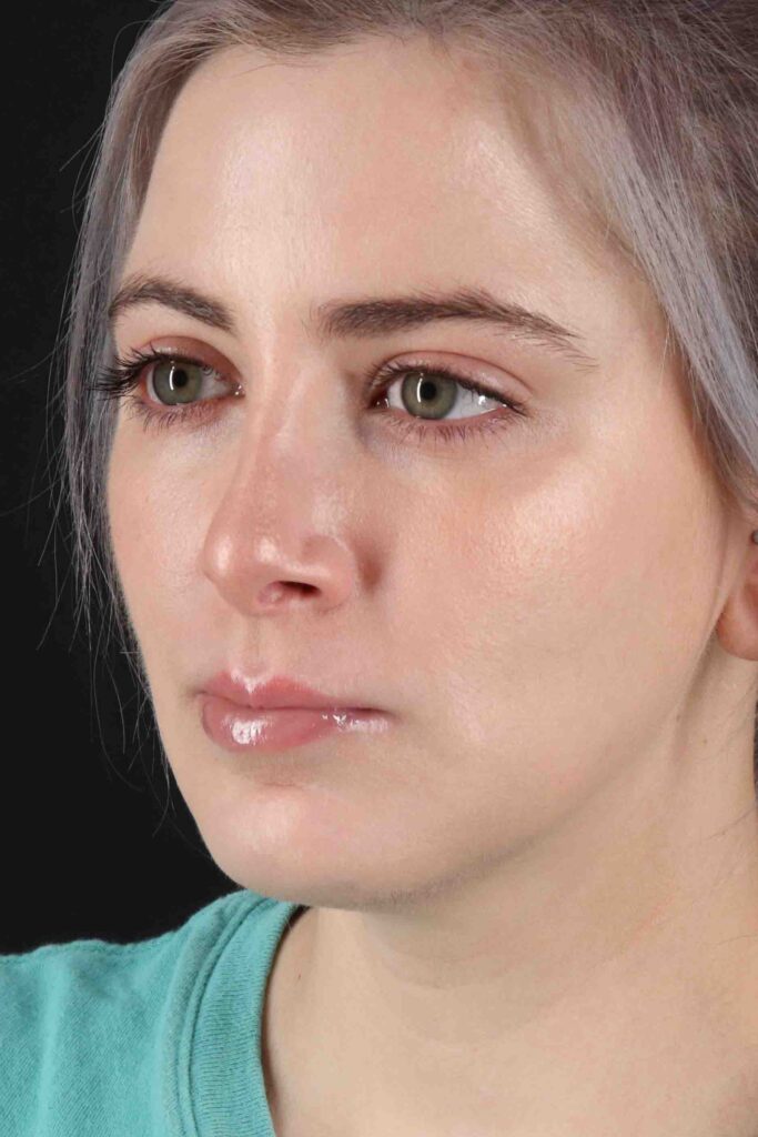 After - left_oblique