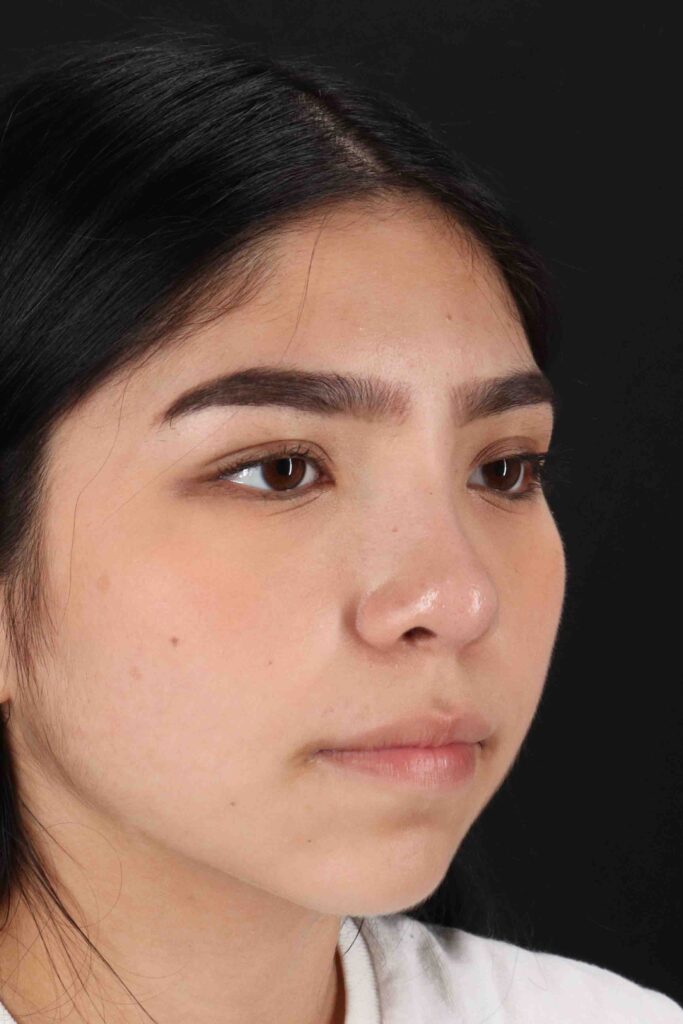 After - right_oblique