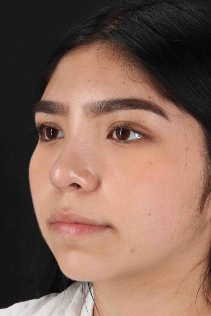 After - left_oblique